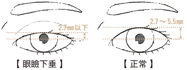 正面を見たとき、上まぶたが瞳孔にかかっていたら眼瞼下垂と診断される