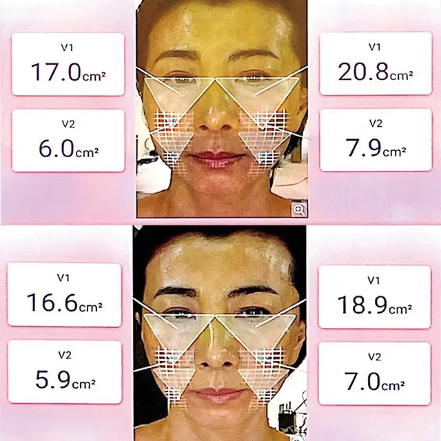 頰の面積が縮小！ 肌の総合スコアもアップ
