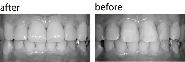 ラミネートベニア