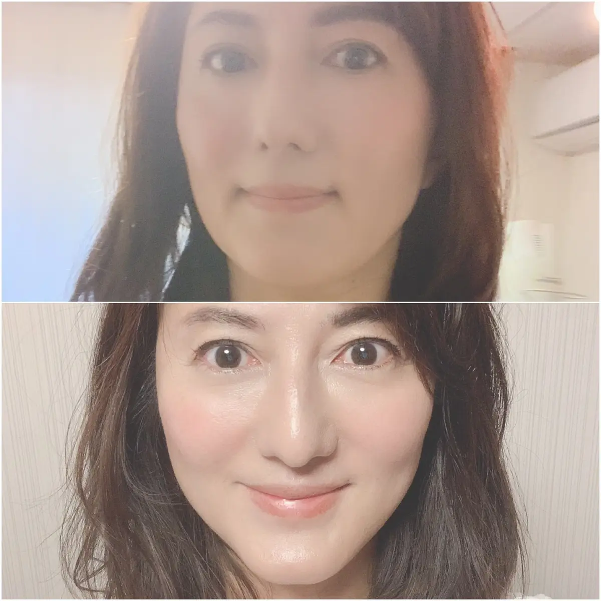 美容針で小顔に❗️の画像_3