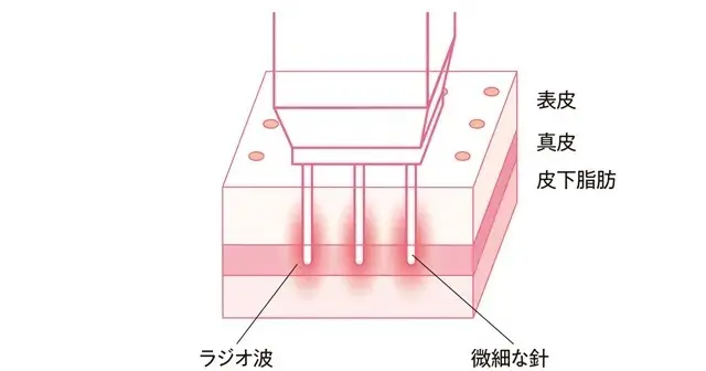 老け見えの原因は「たるみ毛穴」!? 50の画像_38