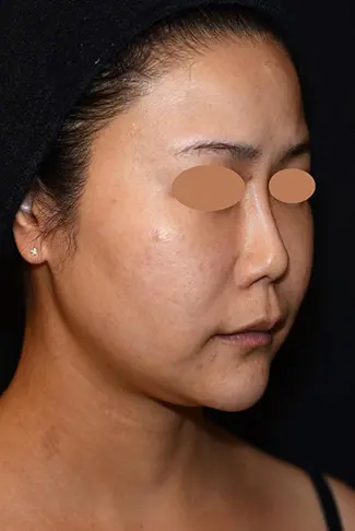 OurAge×Webエクラ  BEFORE