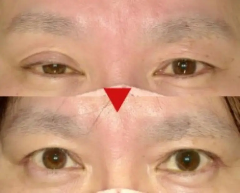 OurAge×Webエクラ  ↑こちらも高田先生が執刀した眼瞼下垂手術の症例。50代女性のビフォー＆アフター（術後１２週間）