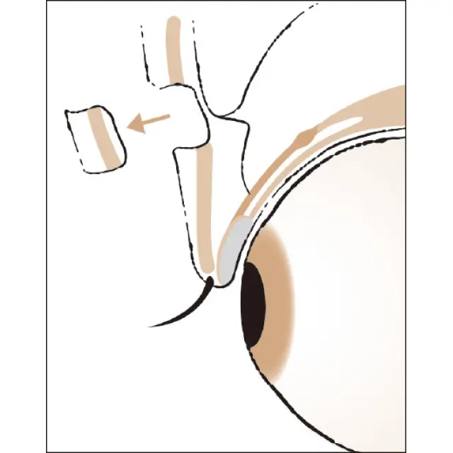 眼瞼余剰皮膚切除術