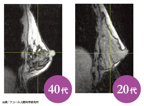 【50代のバスト悩み】形がくずれたバストの画像_5