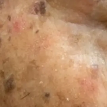 赤みを帯びている部分が日光角化症