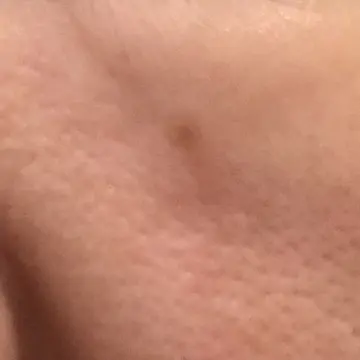 50代の日光角化症の治療終了した時の症状