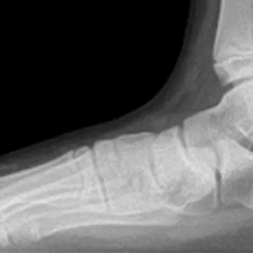 アキレス腱が硬いと、足底を押しつぶし、偏平足に。 