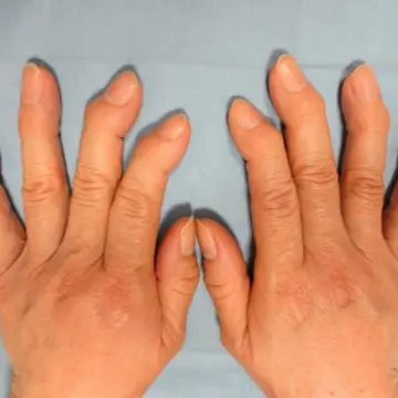 『へバーデン結節』の炎症が進み、第一関節が曲がったケース