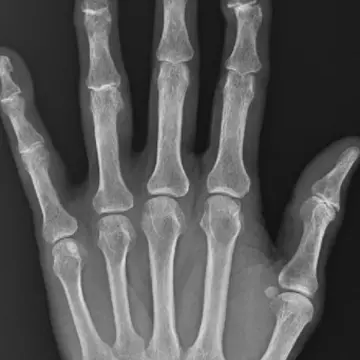 人さし指の第一関節にずれが生じることで曲がる