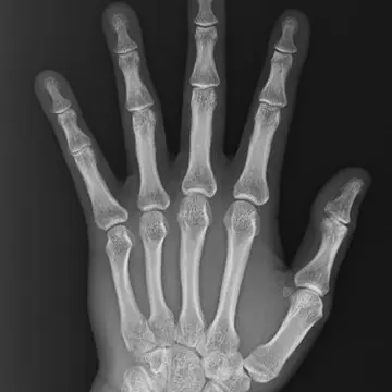 正常な第一関節