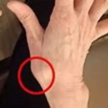 『母指CM関節症』が進んだ状態。ゴツゴツとした見た目に