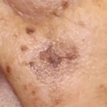 脂漏性角化症と扁平苔癬様角化症が混在。