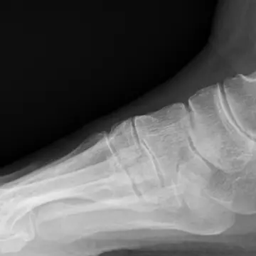 アキレス腱が柔軟だと、足底のアーチがくずれない。