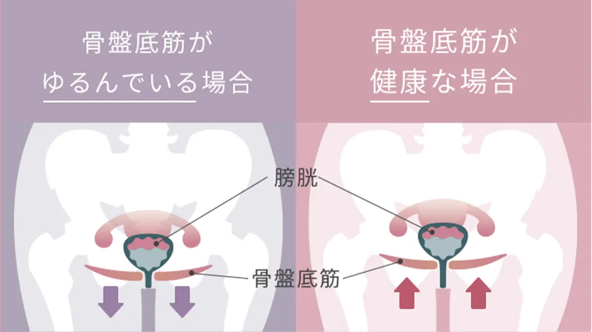 尿もれ対策にSIXPAD Perine Fit（シックスパッド ペリネフィット）で“ながら骨盤底筋トレーニング”　骨盤底筋のゆるみの解説画像