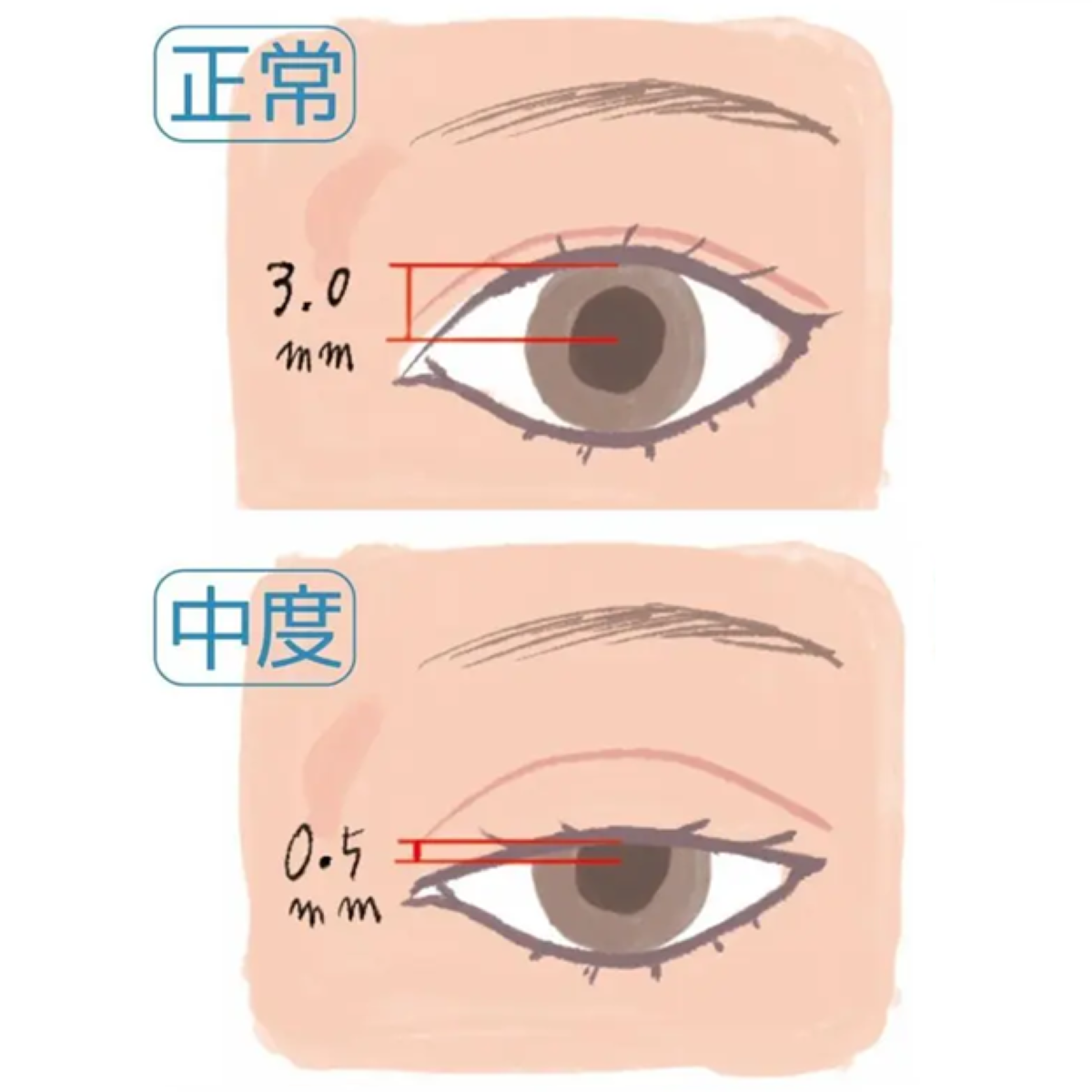 「まぶたが重い」は老化じゃないかも？40代・50代が知っておきたい眼瞼下垂の見分け方
