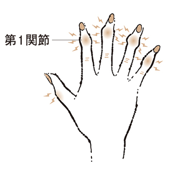 4. 第1関節が腫れ、変形する “べバーデン結節”【50代のお悩み・更年期の手指問題】