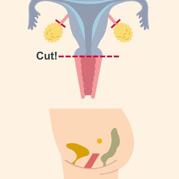 子宮筋腫の手術で子宮を取るとどうなるかイラスト解説。5人の体験談も必見
