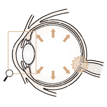 自覚がないまま進行してしまう「緑内障」は、早期発見が要（かなめ）！