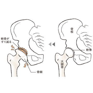【50代、足と脚の違和感】変形性股関節症の症状は？原因＆対策って？
