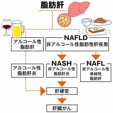 「脂肪肝」は痩せ型やお酒を飲まない女性にも多い。意外な原因は？