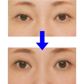 まぶたのたるみはサーマクールアイ引き締めて【美容クリニックで「たるみ顔」悩み解消】