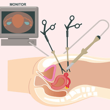 子宮筋腫手術の主流となった「腹腔鏡下手術」のメリットとデメリット