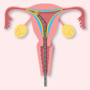 【子宮筋腫の手術法】お腹を切る？切らない？ 全摘する？ 妊娠を望む？ 自分にとっての最良なもの見つけて