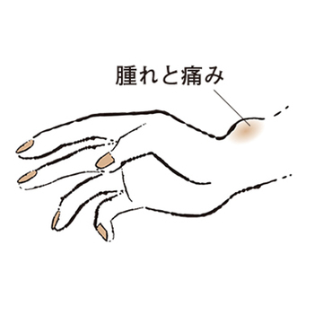 2. 親指側の手首が痛む “ドケルバン病”【50代のお悩み・更年期の手指問題】