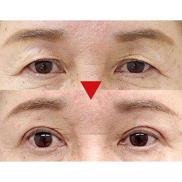 【医師の本音対談】眼瞼下垂（がんけんかすい）の治療や手術、後悔しないクリニック選びのポイントは？