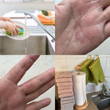 50代の手荒れは「主婦手湿疹」かも？すぐ実践できるケア法【小田ユイコ×若松町こころとひふのクリニック院長 檜垣祐子先生対談】