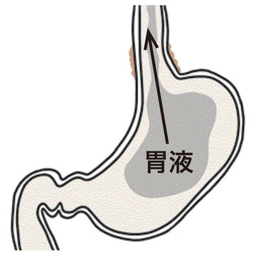 胸やけ、胃のムカムカは「逆流性食道炎」の可能性あり！発生原因や治療法は？