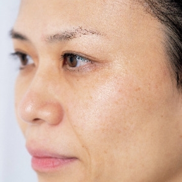 【美容クリニックでシミとり】基本を知ってギモンや不安を解消！