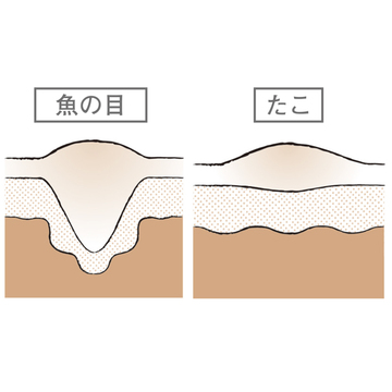 【50代、足と脚の違和感】たこ・魚の目をケアするときの注意点は？ 医師が解説！