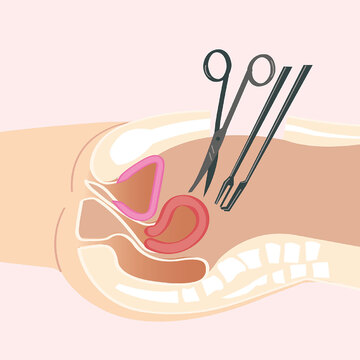 どんな子宮筋腫にも対応できる「開腹手術」のメリットとデメリット