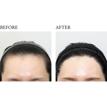 【50代「増毛」の最新トピックス】韓国で今話題！“自毛植毛”クリニックでボリュームアップ！