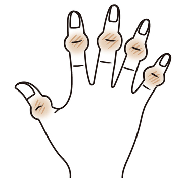 50代の手指の不調、“変形性関節症”が関係しているかも！