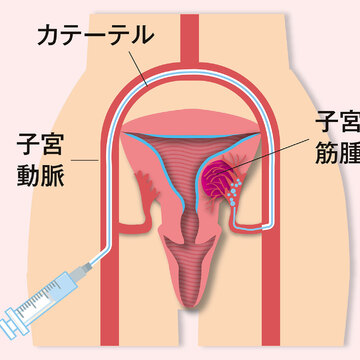 妊娠を望まない人に適用！ 子宮筋腫のお腹を切らない3つの治療法