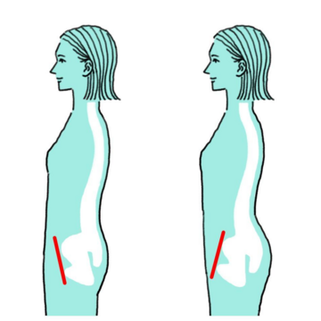 骨盤の歪みやバナナ腰を改善すると血圧＆コレステロール値も下がる！？その理由とは？
