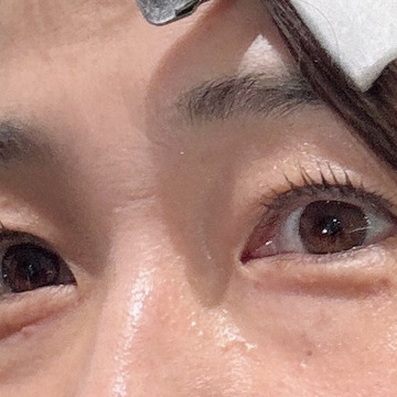 目の周りのシワ、なかったことに❗️