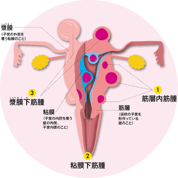 40～50代の5割以上が子宮筋腫を抱えている！子宮筋腫の種類や治療法を専門医が解説