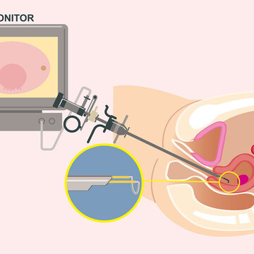 子宮筋腫の手術、開腹せずにすむ「子宮鏡下手術」はどんな人なら可能？デメリットは？