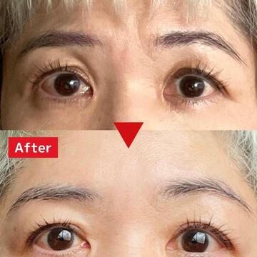 【眼瞼下垂手術の体験レポート 後編】手術、術後の経過、回復を早めるポイントや手術にかかった費用は？