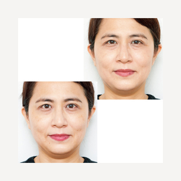 ＜今日から本気の「たるみ目」ケア＞目の疲れを軽減しながら、ぱっちり印象に！「女優鍼コース」体験ルポ