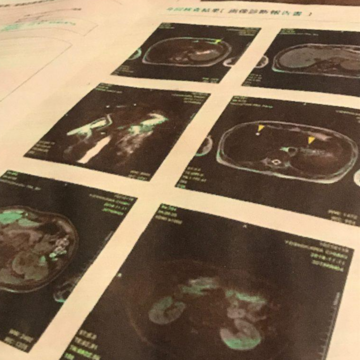 γ-GTP（ガンマジーティーピー）の数値が上昇していって…閉経後、肝機能が悪くなるのは本当？【老けないための更年期から始めるヘルスケア】