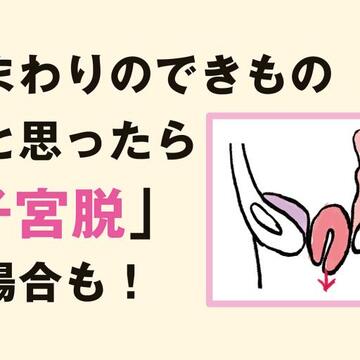 膣まわりのできものが実は「子宮脱」だった！臓器脱をイラストで詳しく解説【更年期の基礎知識Q&A】