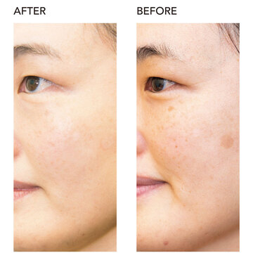 「美容クリニックでシミとり」をした肥大ジミは、2年後の今どうなっている!?