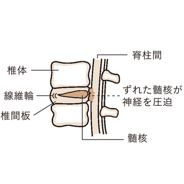「ぎっくり腰」の引き金は前かがみの姿勢！ 毎日の“ちりつも”が悲劇を引き起こす
