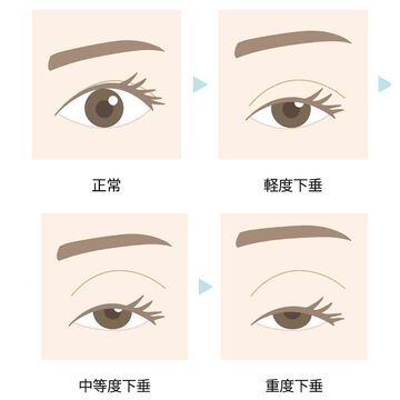 まぶたが下がってきて、目が小さく見える…。たるみ？ それともこれが噂の眼瞼下垂？ 眼科医が解説