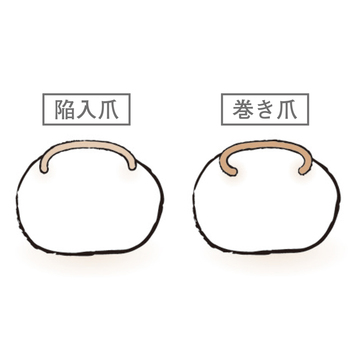 【50代、足と脚の違和感】痛みが出ると辛い！爪の変形の予防＆緩和を医師が解説！